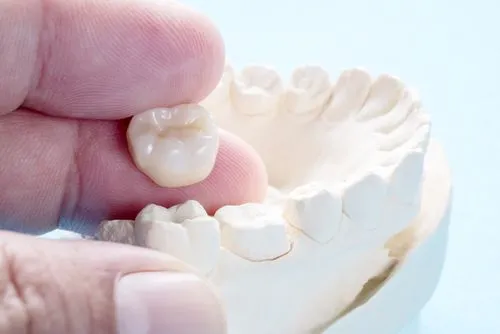 Same-Day Crowns at AL Dental Studio