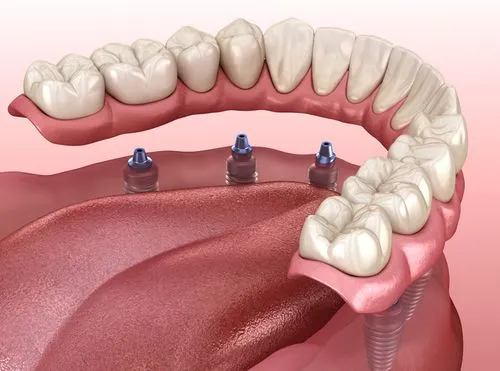 All-on-4 / All-on-6 Implants at AL Dental Studio