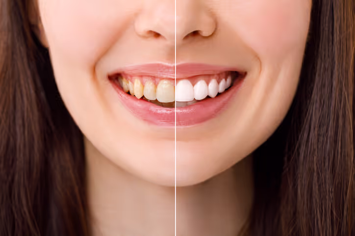 Teeth Whitening at AL Dental Studio