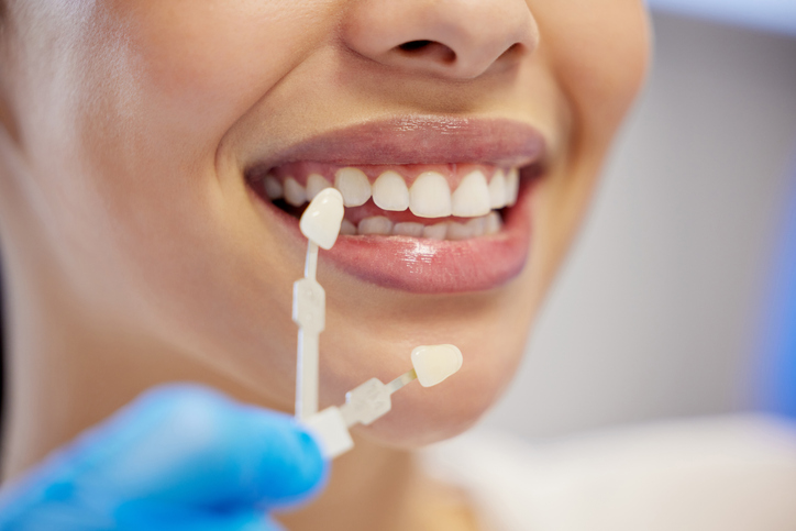 Porcelain Veneers at AL Dental Studio