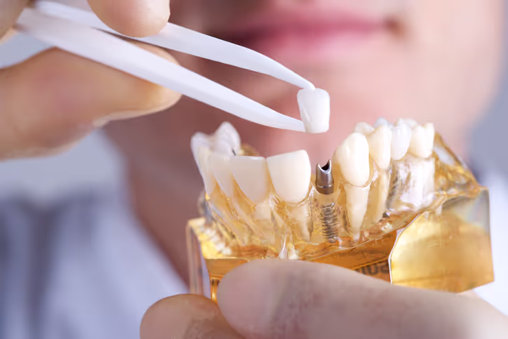 Dental Implants at AL Dental Studio